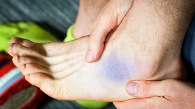 ankle-sprain-treatment-for-first-second-and-third-degree-sprains