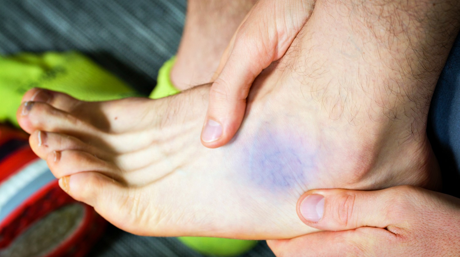 Featured | Bruise near ankle, common runners contusion | Ankle Sprain Treatment For First, Second, And Third Degree Sprains